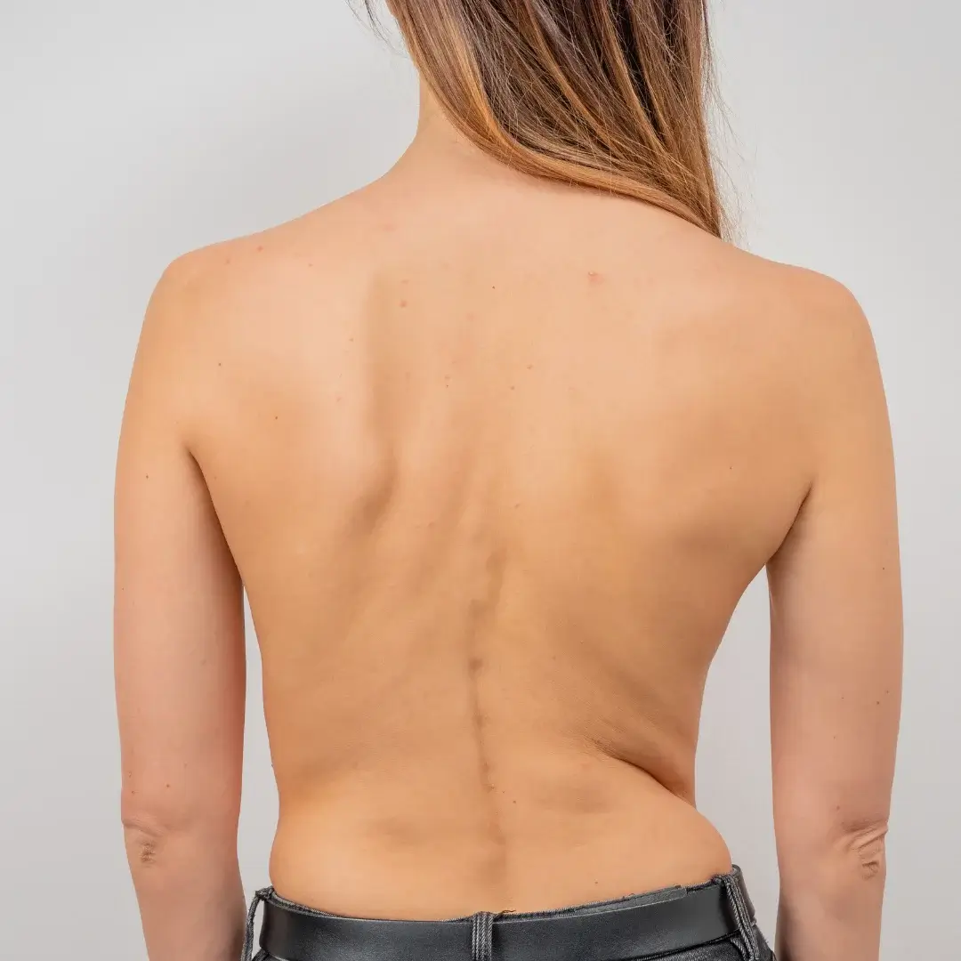 Chiropractic care for scoliosis pain management