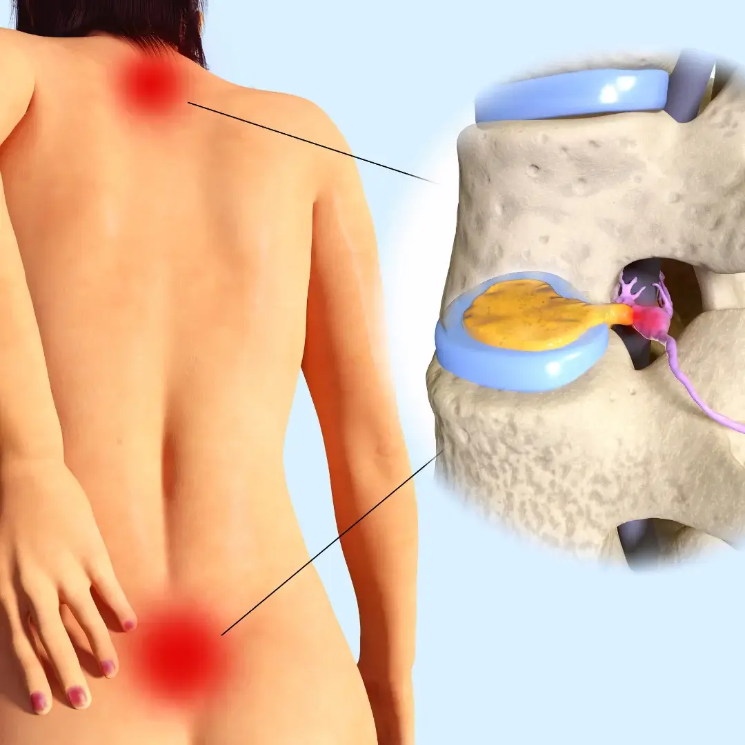 Chiropractic care for disc protrusion