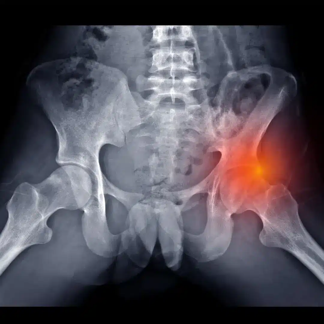 Chiropractic treatment for piriformis syndrome pain